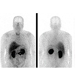 Body scan showing radiotracer accumulating in the body.