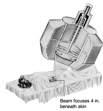 Diagram of the apparatus used for external beam radiation therapy.