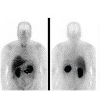 Body scan showing radiotracer accumulating in the body.